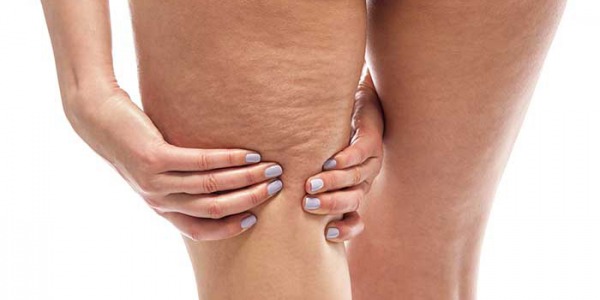 La cellulite : pas seulement une question d’esthétique