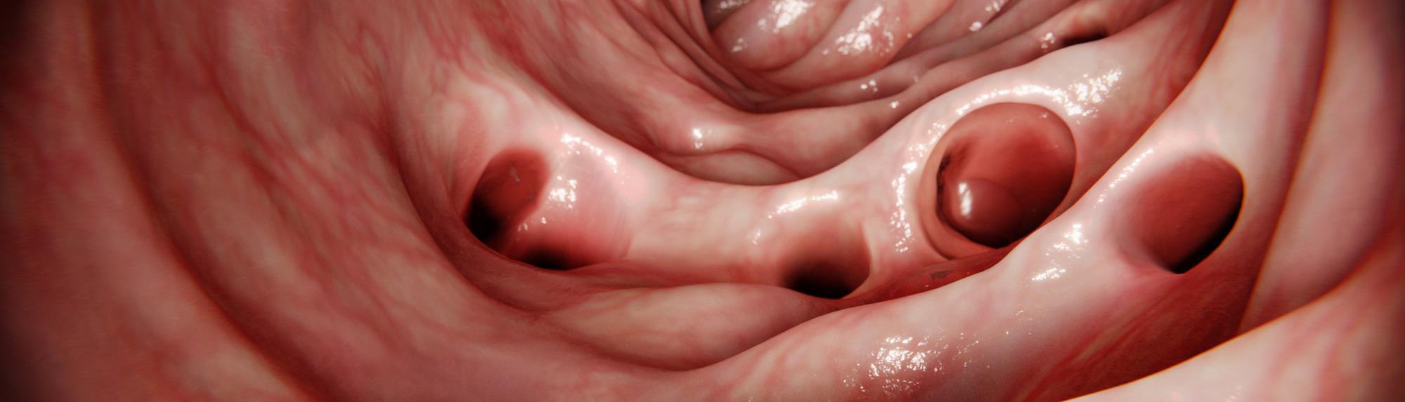 Attention aux diverticules