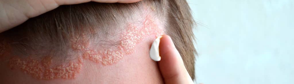 Dermite séborrhéique : que faire ?