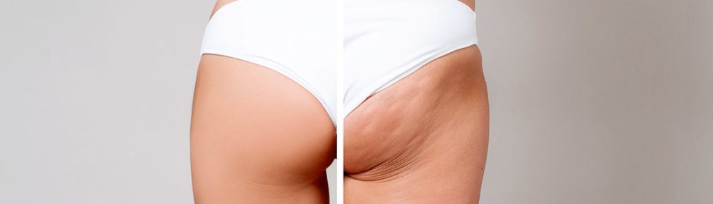 La cellulite : pas seulement une question d’esthétique